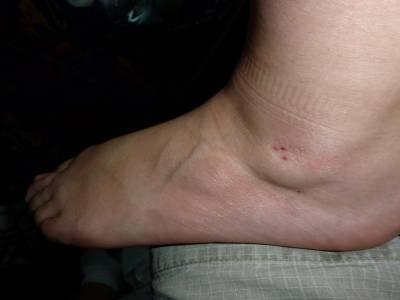 4 piqures pour ce pied et une pour l'autre